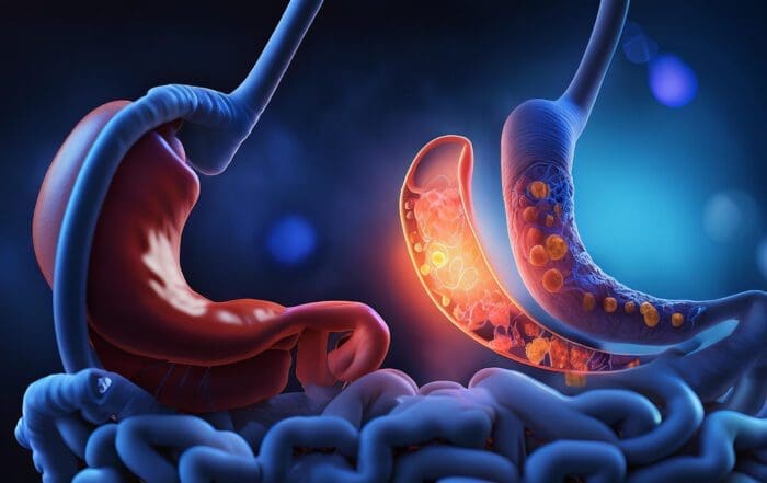 mini gastric bypass in Mexico