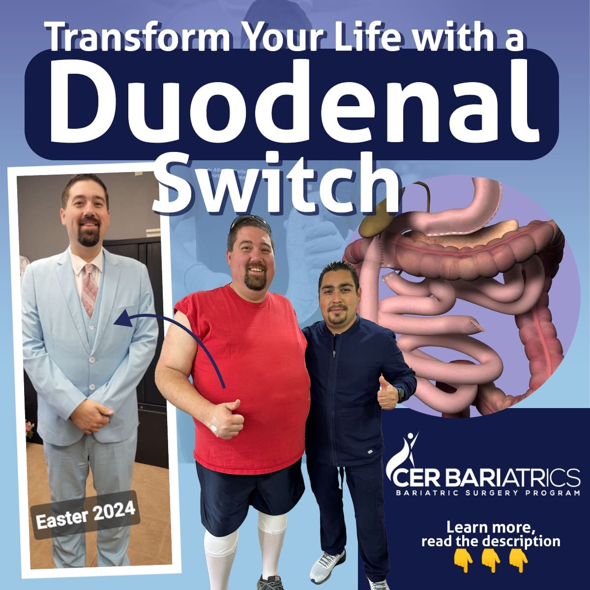 duodenal switch before and after review duodenal switch before and after review